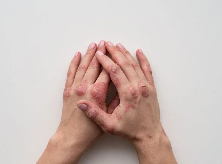 Stressed Skin? Unmasking the EczemaStress Connection